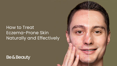 How to Treat Eczema-Prone Skin Naturally and Effectively
