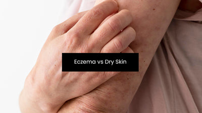 What Is The Difference Between Eczema And Dry Skin?