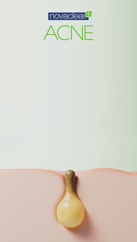 Novaclear Acne Pores-Off Serum – Treatment for Acne Pores On Face with Niacinamide, Salicylic Acid and Azelaic Acid – Targets Blackheads, Whiteheads and Post-acne scars - 30 ML